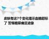 皮肤有这7个变化提示血糖超标了 警惕糖尿病足迹象