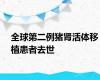 全球第二例猪肾活体移植患者去世